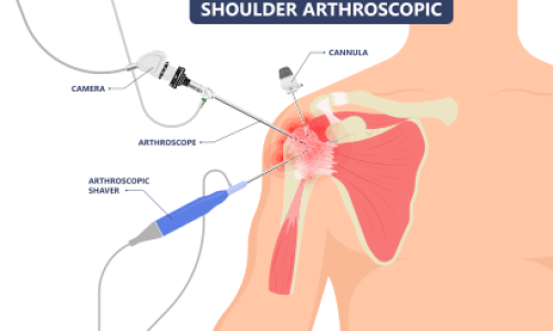 Arthroscopic Bankart Repair