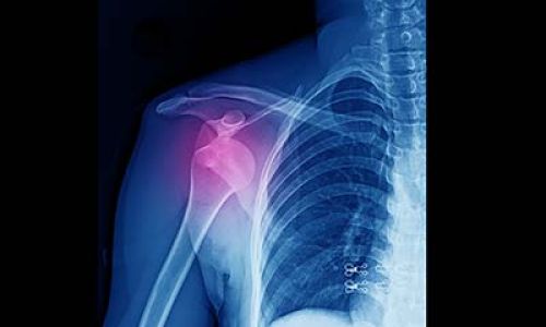 Biceps Release Arthroscopic Surgery